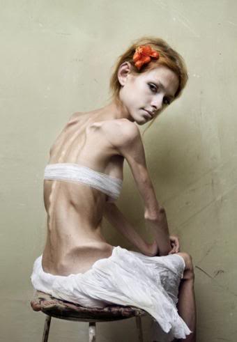 Ana Anorexia